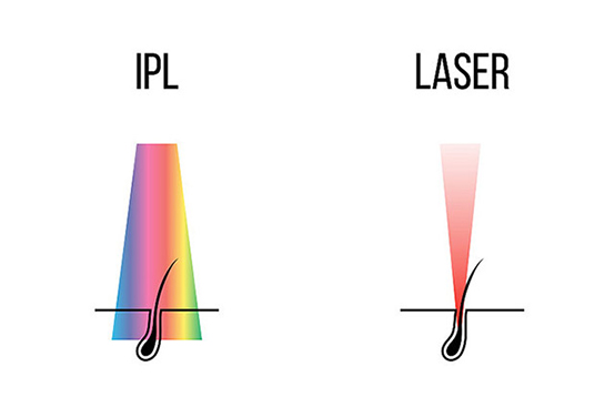 Well-recognized advantages of IPL devices